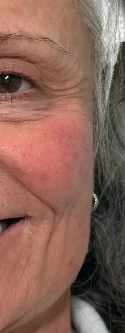 Before: Dysport - 40 units