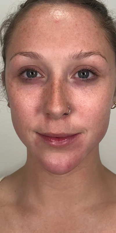 After: Dermal Filler