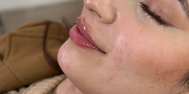 After: Lip Filler