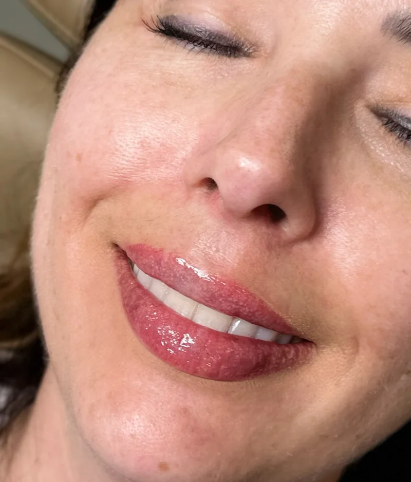 After: Lip Filler - 1 syringe
