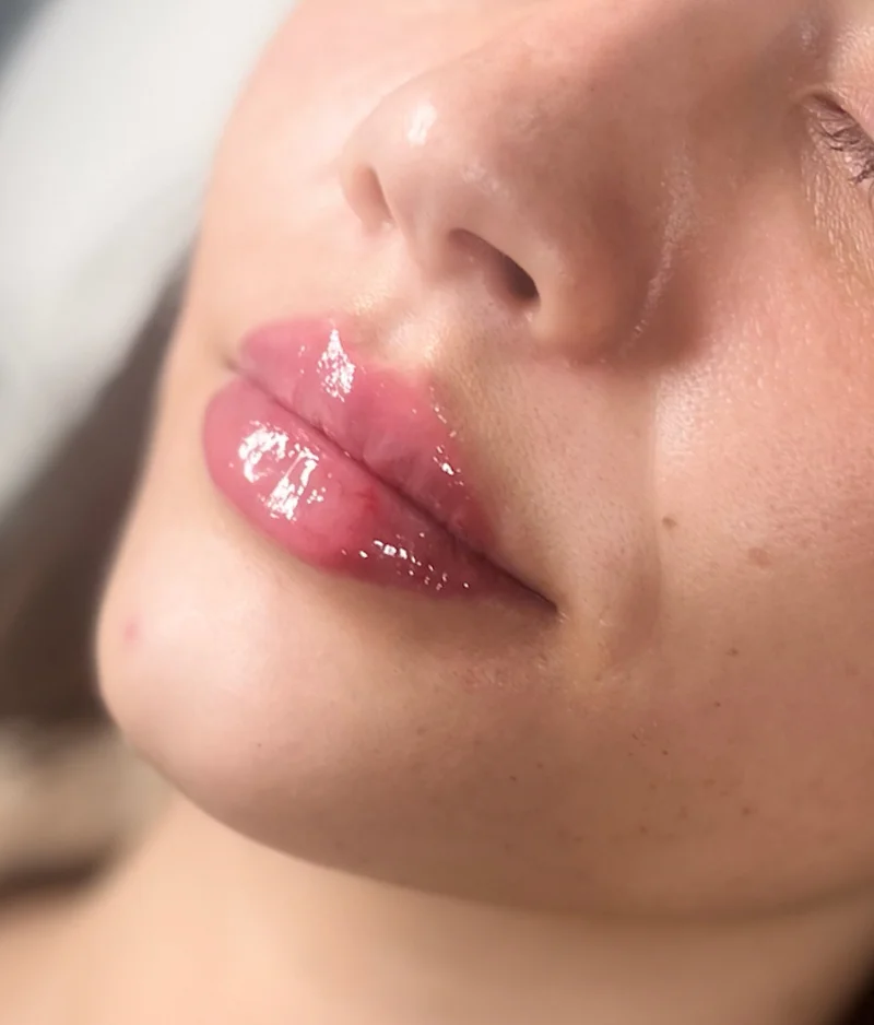 After: Lip Filler - 1 syringe