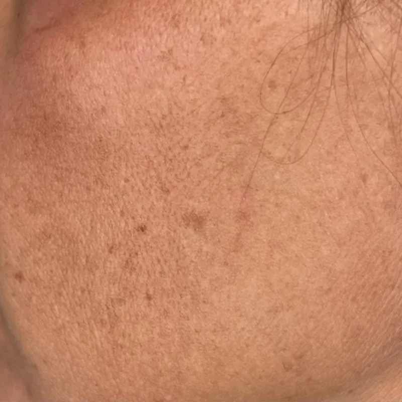 Before: Microneedling - 3 sessions